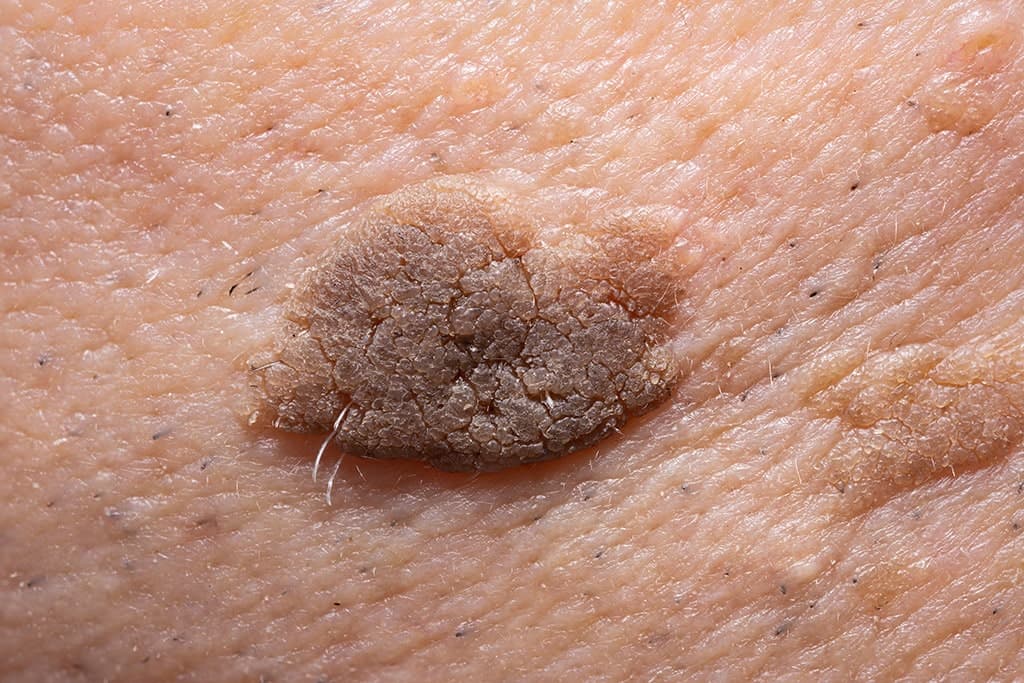 Seborrhoische Keratosen